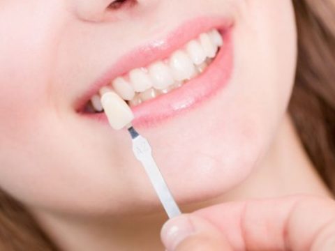 Dán răng sứ có cần mài răng nhiều không?