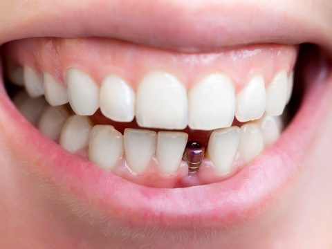 Cấy ghép Implant răng cửa có đau không?