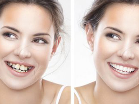 Niềng răng thẩm mỹ giúp bạn tự tin với nụ cười