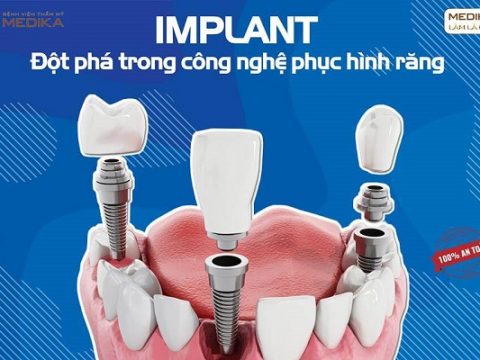 Cấy Implant giá bao nhiêu?