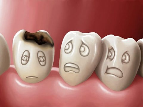 Tẩy trắng răng cho răng sâu có được không?