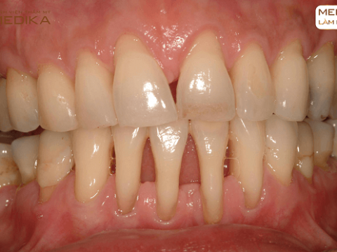 Mất răng do viêm nha chu có cấy ghép răng Implant được không?
