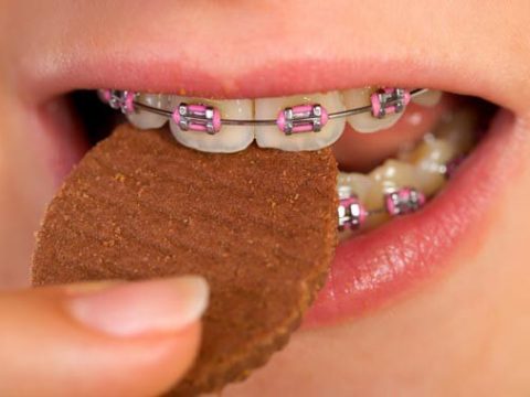 Những thực phẩm nên và không nên ăn khi niềng răng
