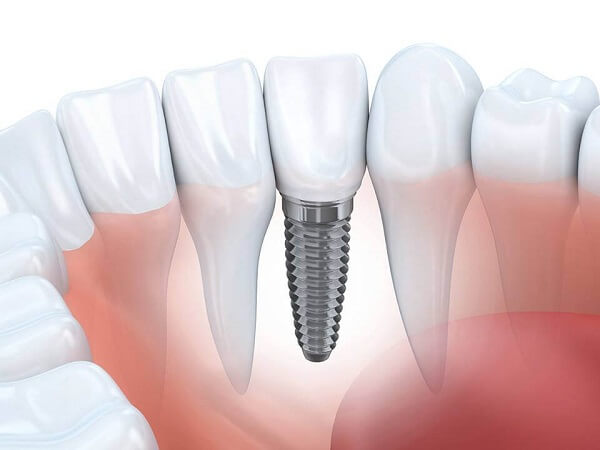 Cấy ghép Implant cho răng thật đã mất Nha Khoa MEDIKA