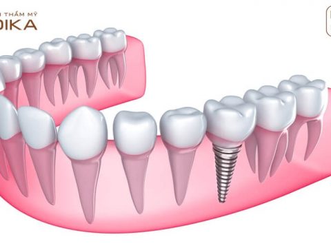 Cấy ghép Implant giải pháp tối ưu cho những trường hợp mất răng