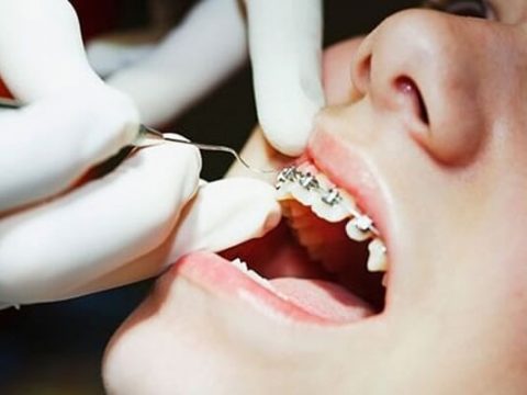 Niềng răng có bắt buộc phải nhổ răng không?