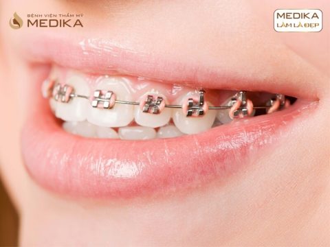 Niềng răng thẩm mỹ có ảnh hưởng đến sức khỏe răng miệng không?