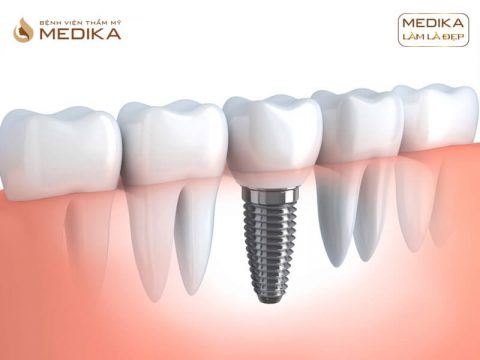 Vì sao Implant là giải pháp phục hình răng nổi bật nhất hiện nay