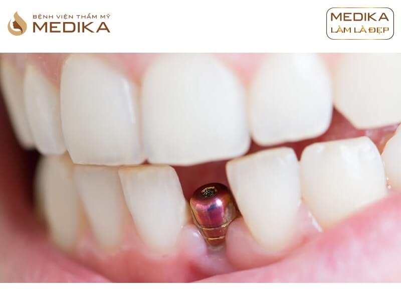 Cách chăm sóc phục hình răng sứ trên Implant để giữ độ bền chắc tại nha khoa MEDIKA