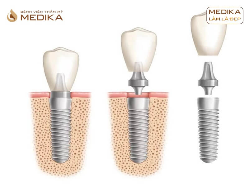 Mất 1 răng nên thực hiện cầu răng sứ hay cấy ghép implant tại nha khoa MEDIKA