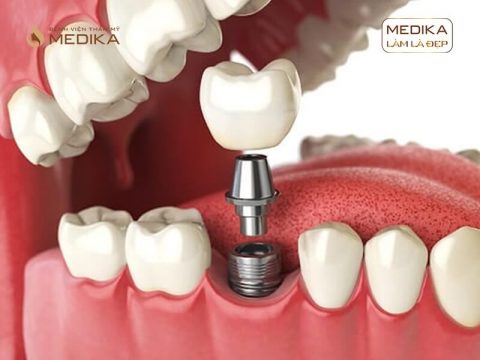 Răng Implant bị đào thải thì phải làm sao?