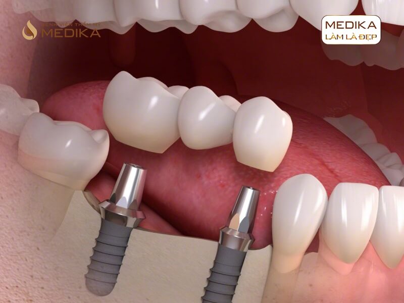 Thực hiện cấy ghép răng Implant bao lâu được gắn răng sứ ở nha khoa MEDIKA